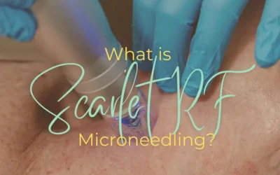 What is Scarlet RF Microneedling?&nbsp;